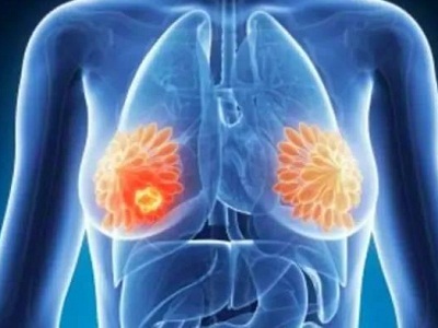 HER2抑制剂在治疗乳腺癌上有什么突出表现？_香港济民药业