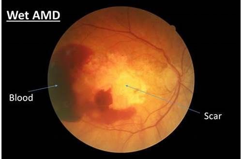诺华新一代眼科药物Beovu美国标签更新：增加视网膜不良事件安全信息！_香港济民药业