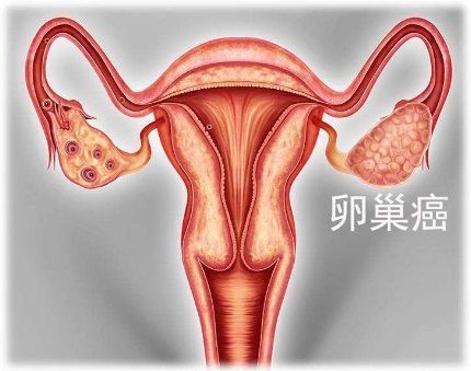 BRCA突变晚期卵巢癌III期临床数据显示：利普卓Lynparza一线维持治疗，无进展生存期＞4.5年(安慰剂仅1年)_香港济民药业