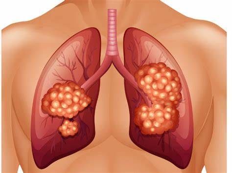 可瑞达Keytruda一线治疗PD-L1高表达肺癌：完成2年治疗的患者，5年生存率81.4%！_香港济民药业
