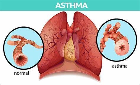 tezepelumab治疗严重不受控哮喘3期试验成功，可能广泛用于重度哮喘群体！_香港济民药业