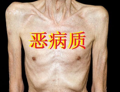 首个治疗癌症恶病质的药物Adlumiz在日本上市，有效增加体重/肌肉质量/食欲_香港济民药业