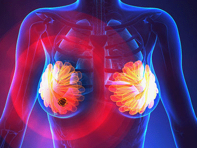 kadcyla对比Herceptin治疗HER2过度的乳腺癌_香港济民药业 kadcyla对比Herceptin治疗HER2过度的乳腺癌_香港济民药业