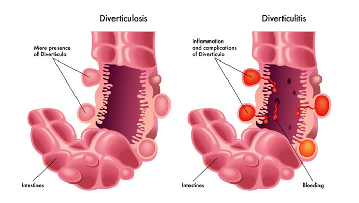 憩室疾病和憩室炎