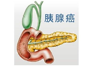 胰腺癌一线治疗！Onivyde（伊立替康脂质体）+化疗(5-FU/LV+OX)联合用药：最佳总缓解率达81.4%_香港济民药业