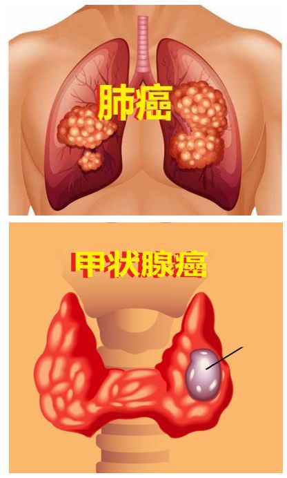 RET抑制剂pralsetinib治疗甲状腺癌在美国申请上市_香港济民药业