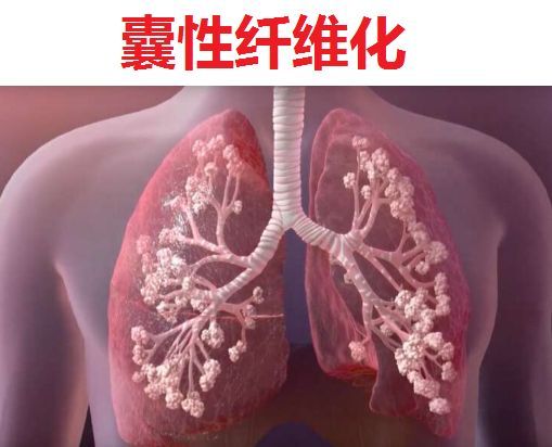 Vertex三款疗法获美FDA受理，治疗囊性纤维化(CF)！