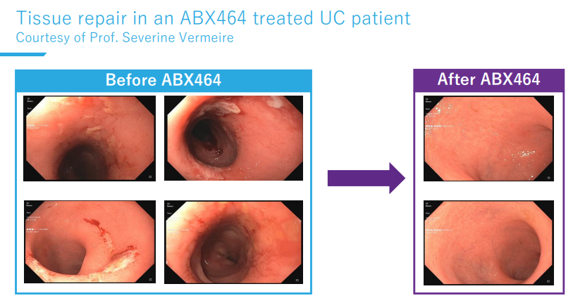 Abivax口服抗炎药治疗溃疡性结肠炎IIa期试验成功