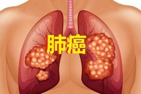 RET非小细胞肺癌新药Gavreto（pralsetinib）获FDA批准，每日口服一次_香港济民药业