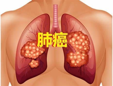 默克靶向抗癌药tepotinib治疗携带METex14跳跃改变的非小细胞肺癌（NSCLC）患者！