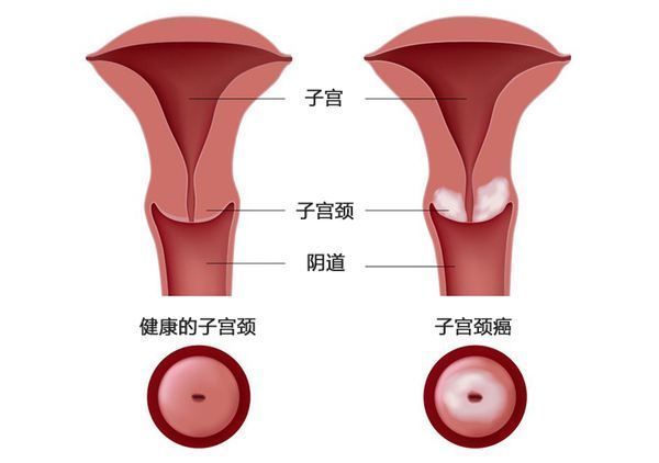 TF靶向抗体药物偶联物（ADC）tisotumab vedotin治疗宫颈癌展现疗效显著！_香港济民药业