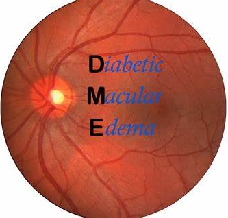 诺华新一代眼科药物Beovu治疗糖尿病性黄斑水肿（DME）2项关键III期研究达到了主要终点_香港济民药业