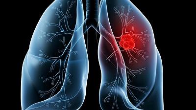 TIGIT靶点免疫疗法tiragolumab：联合Tecentriq治疗PD-L1阳性肺癌总缓解率（ORR）显著提高