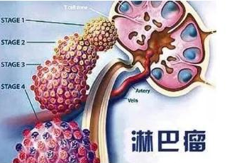 CD19（CAR）T细胞疗法Yescarta用于治疗复发/难治性大B细胞淋巴瘤在日本获批！_香港济民药业