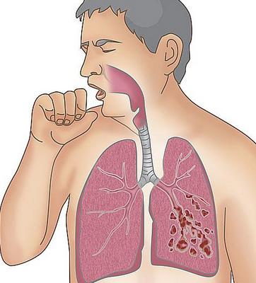 严重哮喘靶向药tezepelumab显著降低哮喘年加重率_香港济民药业
