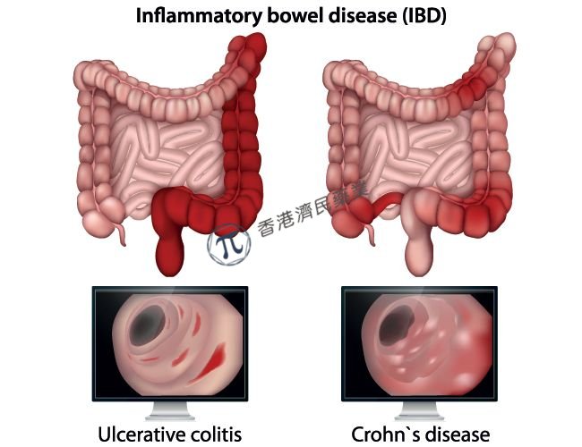 礼来新型抗炎药mirikizumab治疗中重度活动性CD患者显著改善疲劳症状_香港济民药业