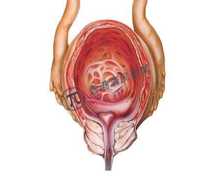 PD-1疗法Opdivo辅助治疗肌肉浸润性尿路上皮癌(MIUC)无论PD-L1表达水平如何,显著延长无病生存期!_香港济民药业