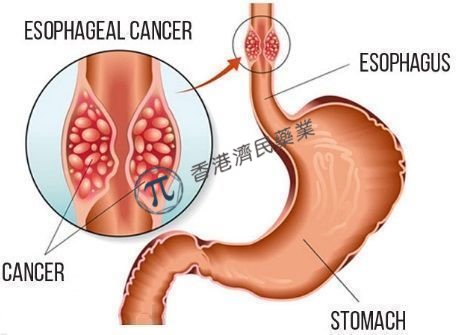 欧盟CHMP推荐批准Opdivo用于食管癌/胃食管连接部癌术后辅助治疗，显著改善无病生存期（DFS）_香港济民药业