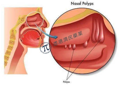 Fasenra（贝那利珠单抗）治疗慢性鼻-鼻窦炎伴鼻息肉III期试验中，同时达到了缩小鼻息肉和减少阻塞的共同主要终点_香港济民药业