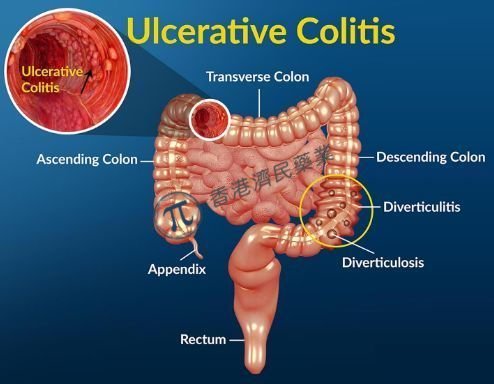 溃疡性结肠炎口服JAK1抑制剂Jyseleca 3期研究疗效与安全性结果公布_香港济民药业