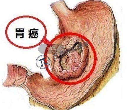 HER2靶向抗体偶联药物Enhertu二线治疗HER2阳性晚期胃癌头对头3期临床研究启动_香港济民药业