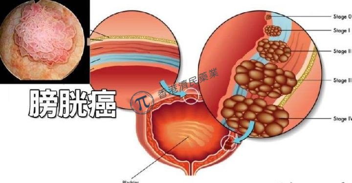 膀胱内灌注卡介苗BCG能有效地治疗膀胱癌吗?