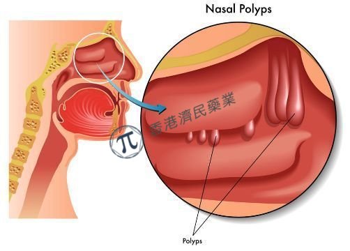 FDA批准抗炎药Nucala(美泊利单抗)第4个适应症：用于慢性鼻-鼻窦炎伴鼻息肉_香港济民药业