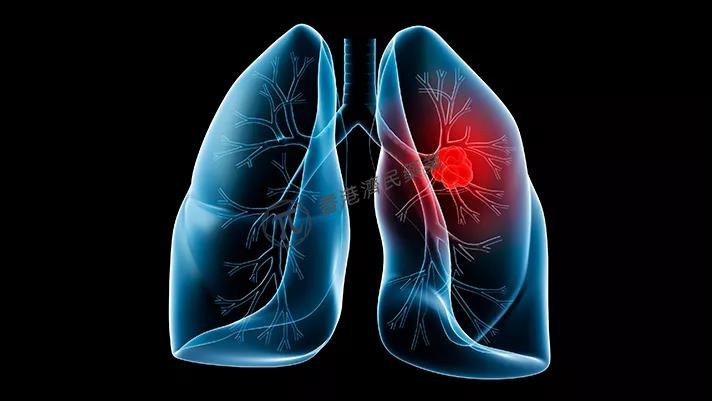 晚期肺癌一线免疫治疗Libtayo+化疗3期临床试验：显著延长总生存期!_香港济民药业