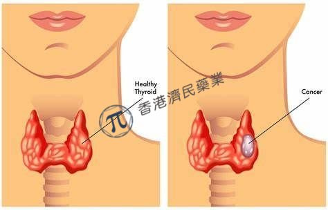 Cabometyx（卡博替尼）治疗放射性碘难治分化型甲状腺癌获FDA优先审查