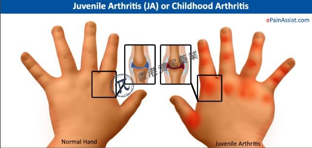 欧盟批准口服JAK抑制剂Xeljanz第四个适应症：治疗2种亚型的幼年特发性关节炎(JIA)!_香港济民药业