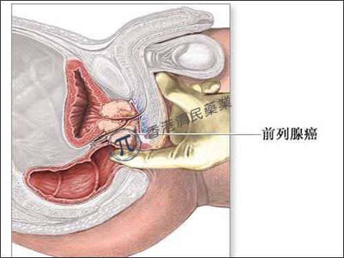 辉瑞BRCA靶向药物Talzenna(talazoparib)治疗晚期前列腺癌2期临床试验疗效优异_香港济民药业