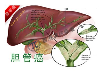 IDH1突变胆管癌靶向新药! TIBSOVO(ivosidenib)获FDA批准新适应症_香港济民药业