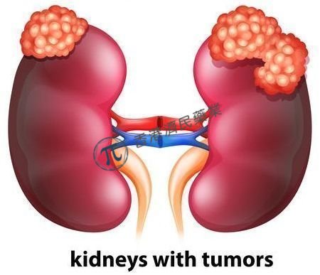 “免疫+靶向”方案Opdivo+Cabometyx在日本获批：一线治疗肾细胞癌(RCC)！_香港济民药业
