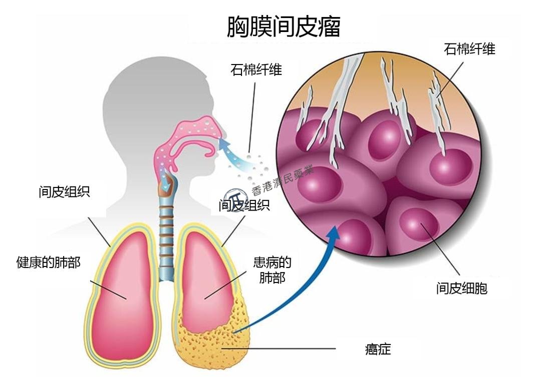 2021年欧洲医学肿瘤学会公布Opdivo+Yervoy一线治疗MPM 3期临床数据：随访3年，显示持久生存益处!_香港济民药业