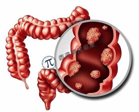 PLK1抑制剂onvansertib治疗KRAS突变转移性结直肠癌（mCRC）疗效显著！_香港济民药业