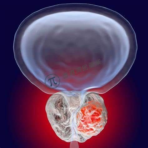 拜耳前列腺癌新药Nubeqa 3期ARAMIS试验表明：延长接受首次前列腺癌相关侵入性手术时间_香港济民药业