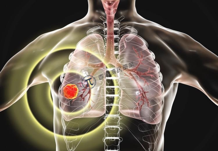 Sotorasib（AMG 510）的临床反应可能因非小细胞肺癌（NSCLC）中的基因组特征而异 _香港济民药业