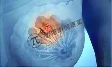 三阴性乳腺癌新药Trodelvy通过Orbis计划获5项批准，显著改善患者生存期 _香港济民药业