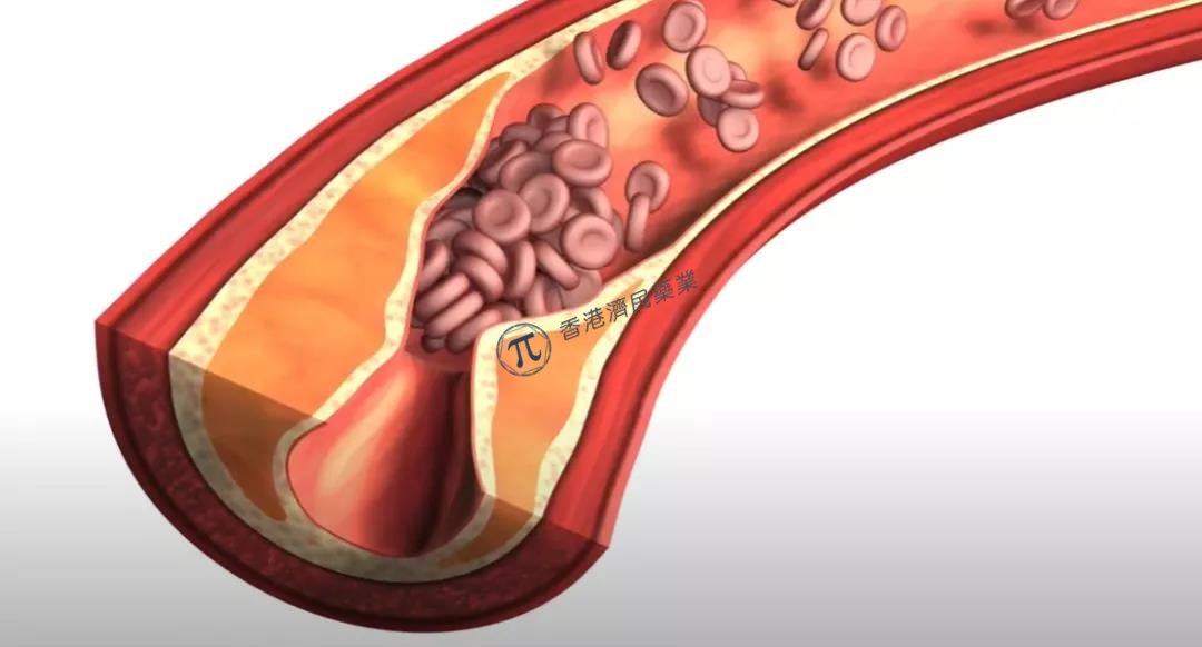 高胆固醇血症首个siRNA疗法Leqvio(Inclisiran)，可降低LDL-C ！_香港济民药业