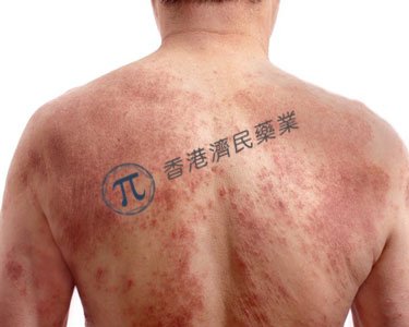 Adtralza（tralokinumab）治疗中重度特应性皮炎青少年关键3期试验：显著改善疗效指标_香港济民药业