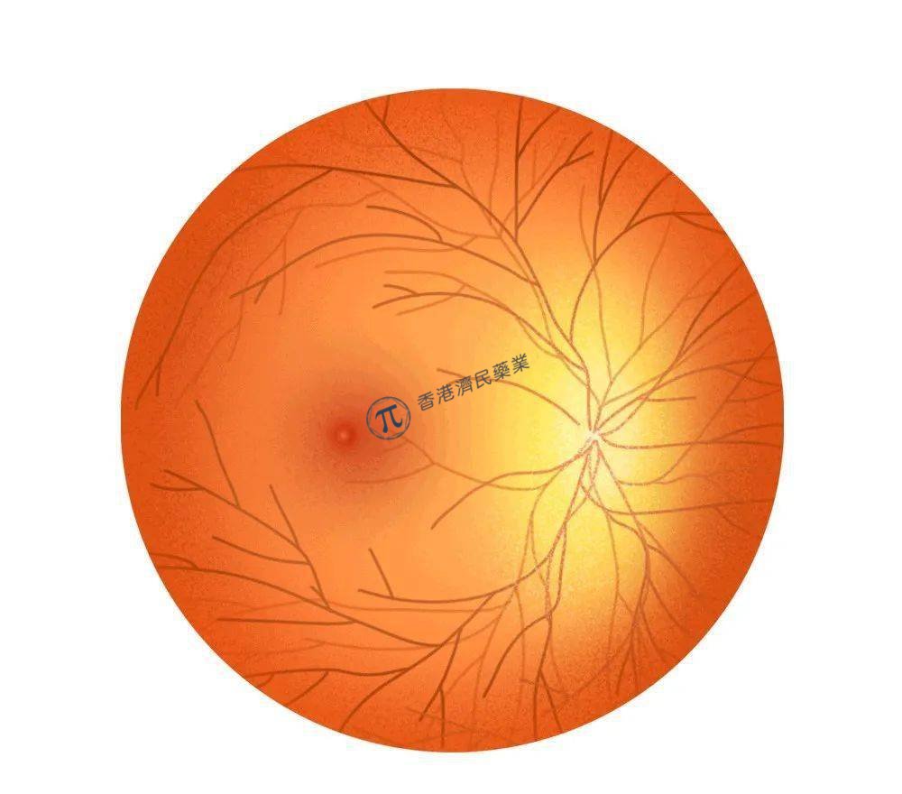 首个将nAMD患者眼球注射次数减少到每年2次的新疗法：罗氏Susvimo_香港济民药业