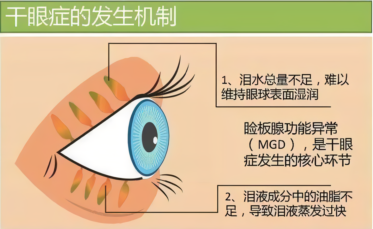干眼症救星|EOS干眼治疗仪|强脉冲光治疗睑板腺功能障碍 - 知乎