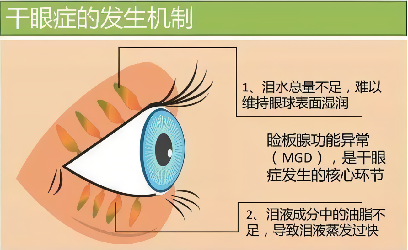 一患儿感冒咳嗽引起的严重球结膜下出血。_结膜下出血_结膜下出血介绍 - 好大夫在线