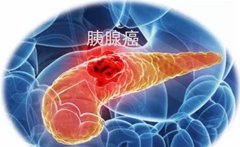 伊立替康脂质体(ONIVYDE)对转移性胰腺癌的最大耐受剂量如何？_香港济民药业