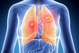 Adagrasib用于既往治疗的KRAS G12C突变非小细胞肺癌（NSCLC）进入审查 _香港济民药业