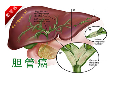 美国FDA优先审查FGFR2+胆管癌新药Futibatinib(TAS-120)