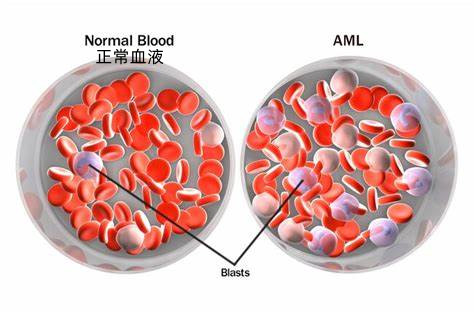 在突变型急性髓细胞白血病(AML)中，与安慰剂相比，Tibsovo和阿扎胞苷产生显著的临床益处_香港济民药业