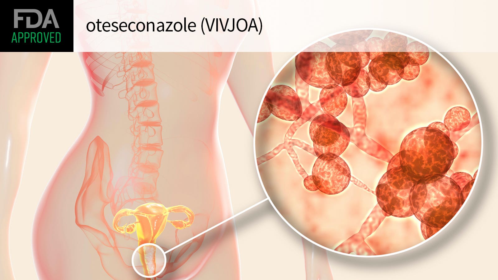 第一种经FDA批准用于治疗复发性外阴阴道念珠菌病(慢性酵母感染)药物：Vivjoa