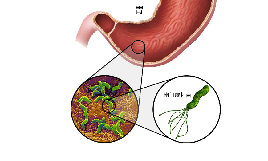 成人幽门螺杆菌感染新药Voquezna三联和双联包获FDA批准_香港济民药业
