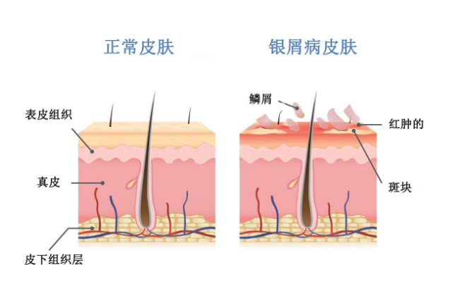 每天一次、不含类固醇的局部治疗斑块型银屑病方法！FDA批准Vtama(tapinarof)乳膏1%_香港济民药业